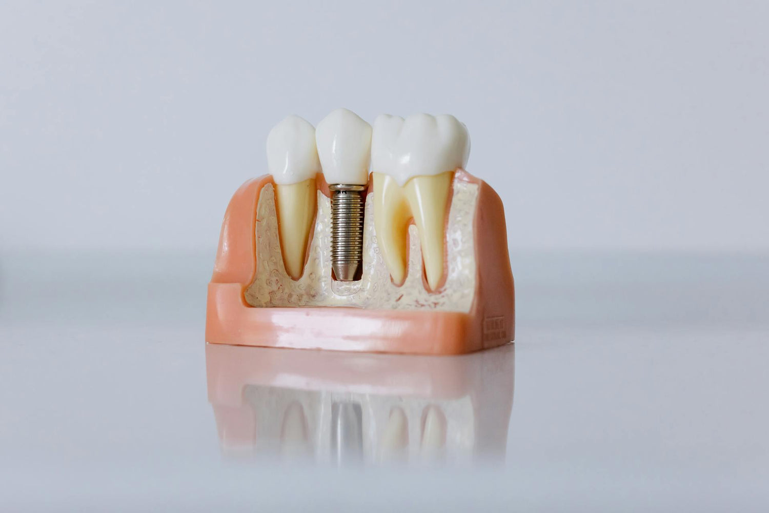 teeth, dental, dental implants, dental milling